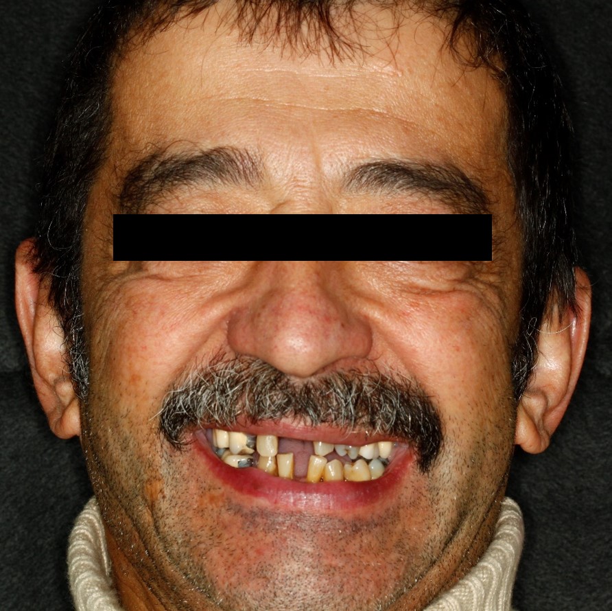 before-and-after-missing-and-malaligned-teeth-before.jpg