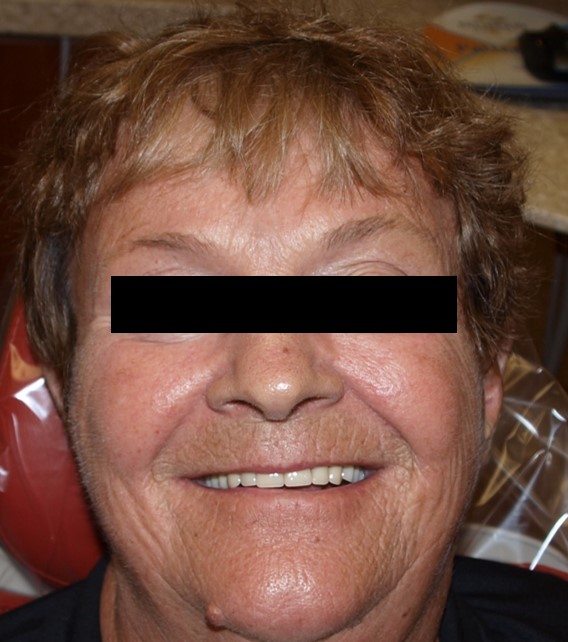 before-and-after-unesthetic-denture-after.jpg